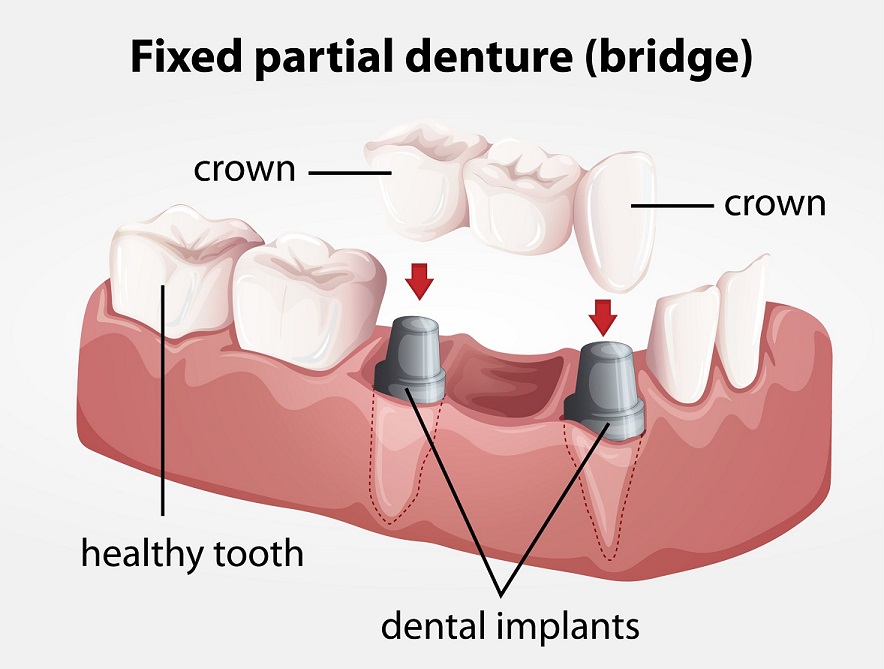 What are some different types of dental diagrams?