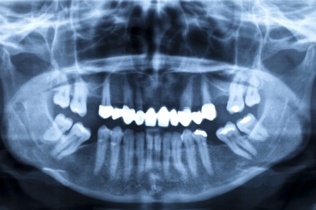 dental x-rays image