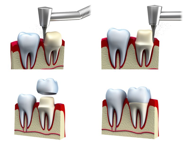 Dental Crown Photo