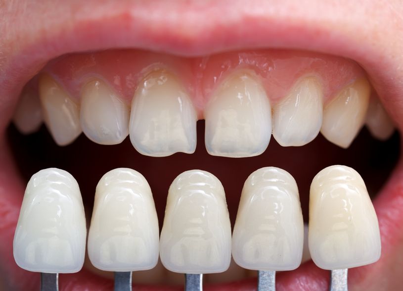 Dental Veneers Image