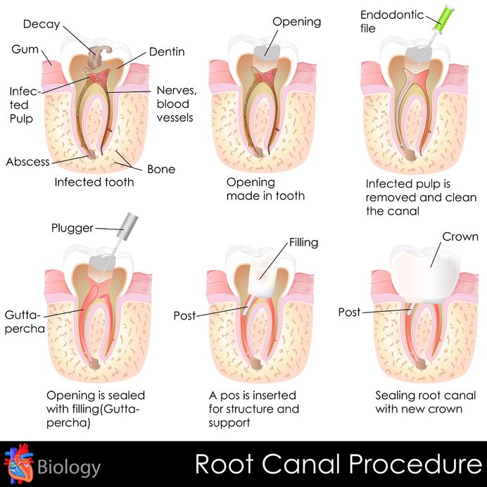 Root Canal Treatment Image 2