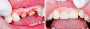 Teeth Bonding Info.
