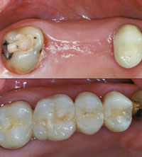 Dental Bridge Image