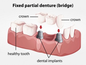 Dental Bridge Image, dental implant image