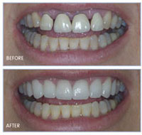 teeth bonding Image