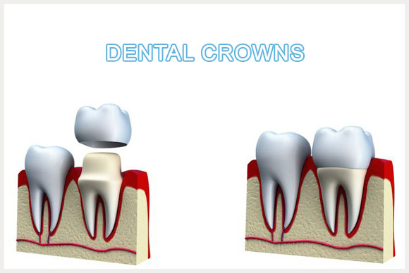 Dental Crown Image