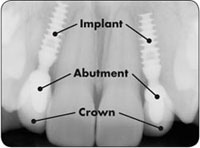 Dental Implants Image