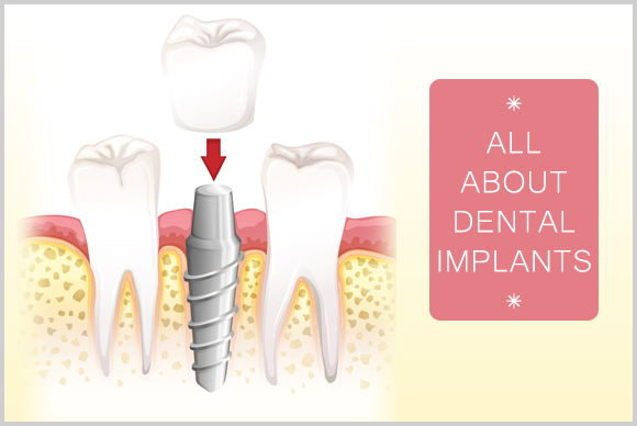 Dental Implants Image