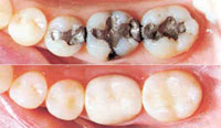 mercury free dentistry image