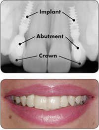 dental implants image