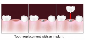 Dental Extraction Procedure