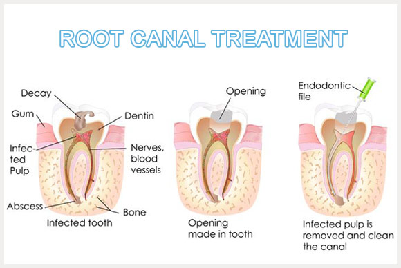 Root Canal Treatment Image