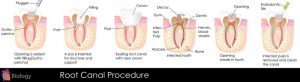 Root Canals Image