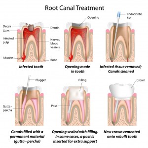 White Filling Info.