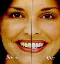 teeth whitening and bleaching