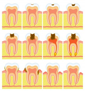 Gum Disease Info.
