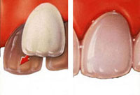 dental veneers image